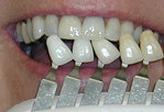 Teeth Whitening in Columbus GA